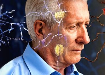 ¿Por qué se produce el Alzheimer?